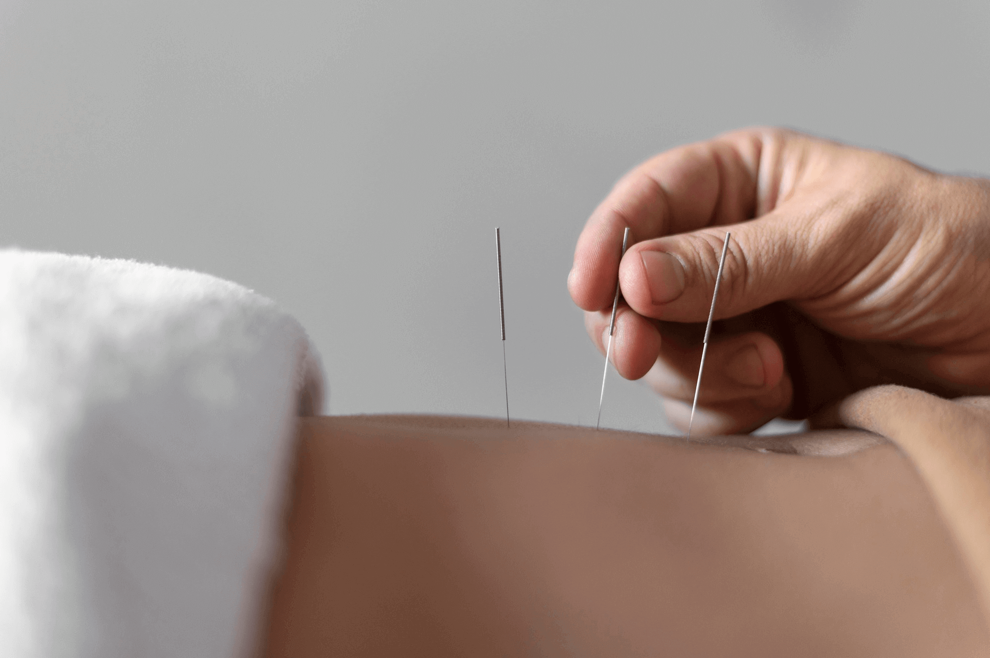 Fertility Acupuncture In Supporting Your Path to Parenthood