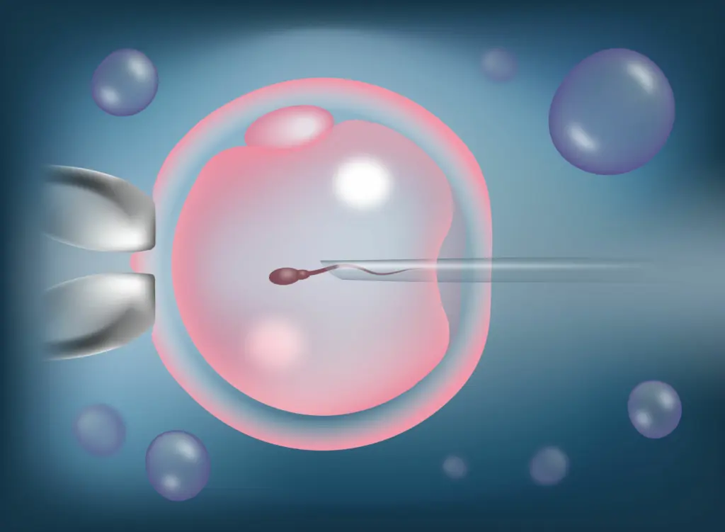 ICSI in IVF: what do you need to know