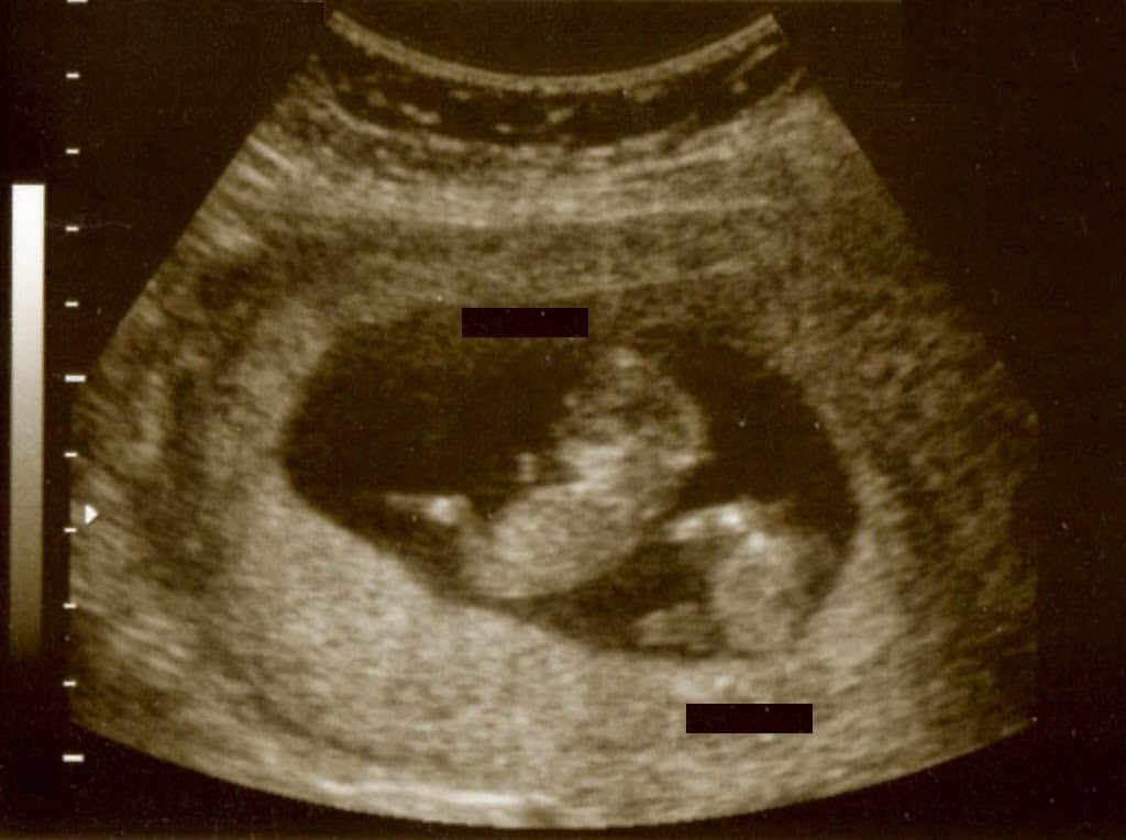 Egg Donor Family gallery photo